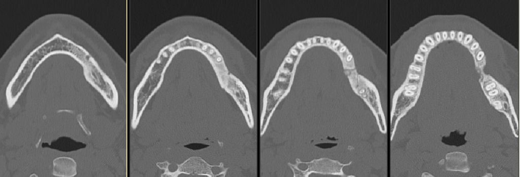 CT axial noncontrast bone windows.
