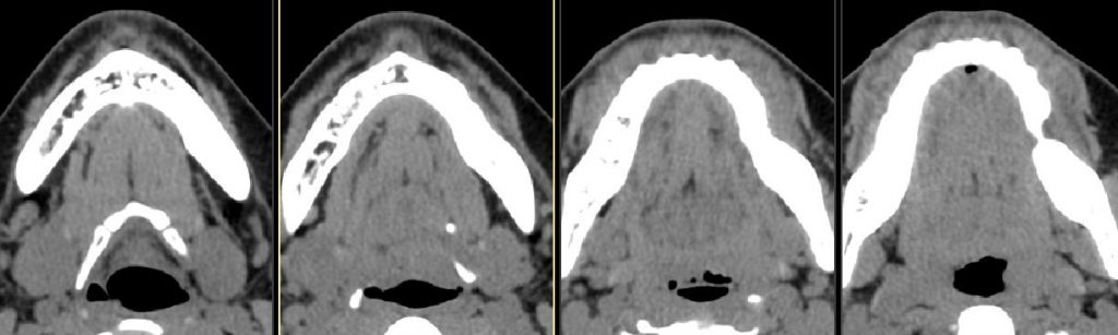 CT axial noncontrast soft tissue windows.