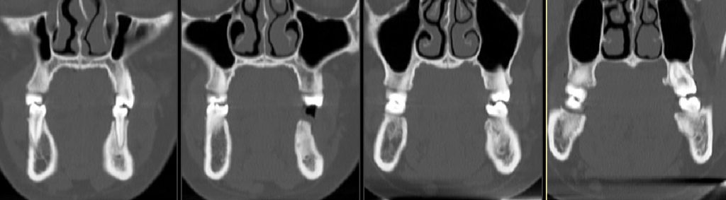 CT coronal noncontrast bone windows.