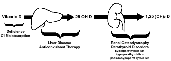 Osteomalacia Diagram.