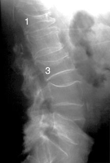 Osteoporosis Spine.
