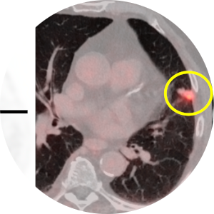 Prostate cancer.
