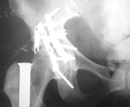 Pelvic Recon Plates.