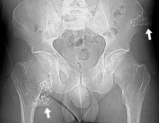 Pelvis Arrows.