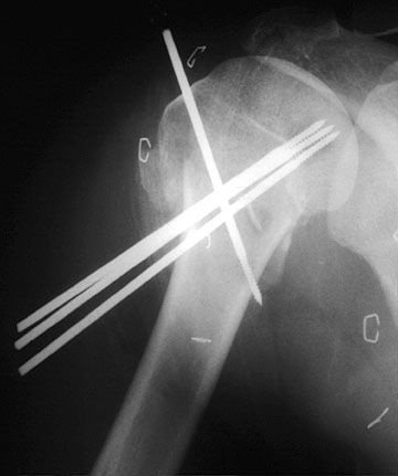 Percutaneous Pins.