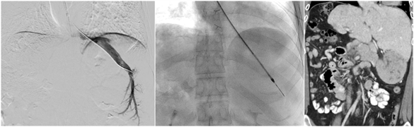 Portal-Hypertension-and-Mesenteric-Interventions.