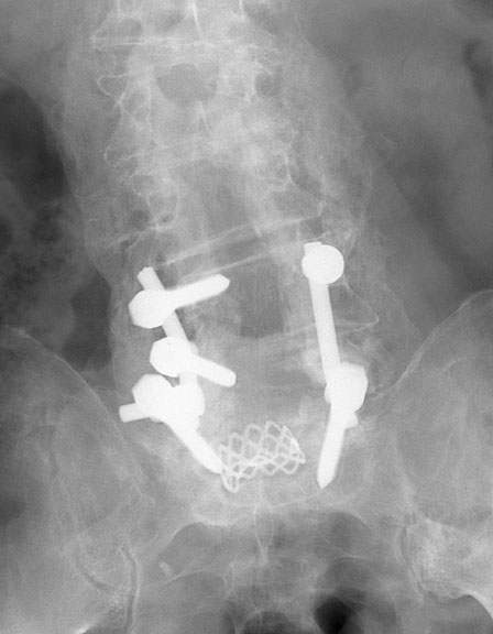 Post Spinal Rods AP.