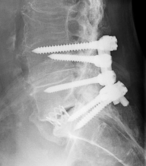 Post Spinal Rods Lat.