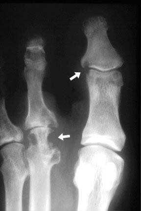 RA Toes.