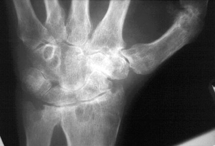 RA Wrist.