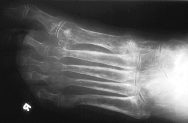 RSDS Foot.