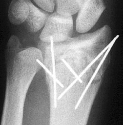 Radial K Wires.