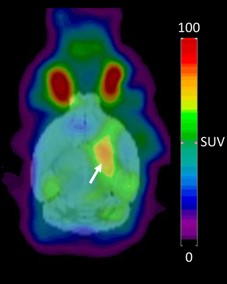 PET scan with SUV heat map.
