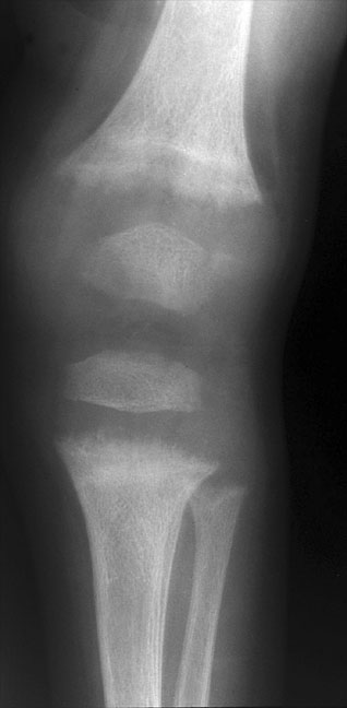 Rickets Knee MP4 Small.