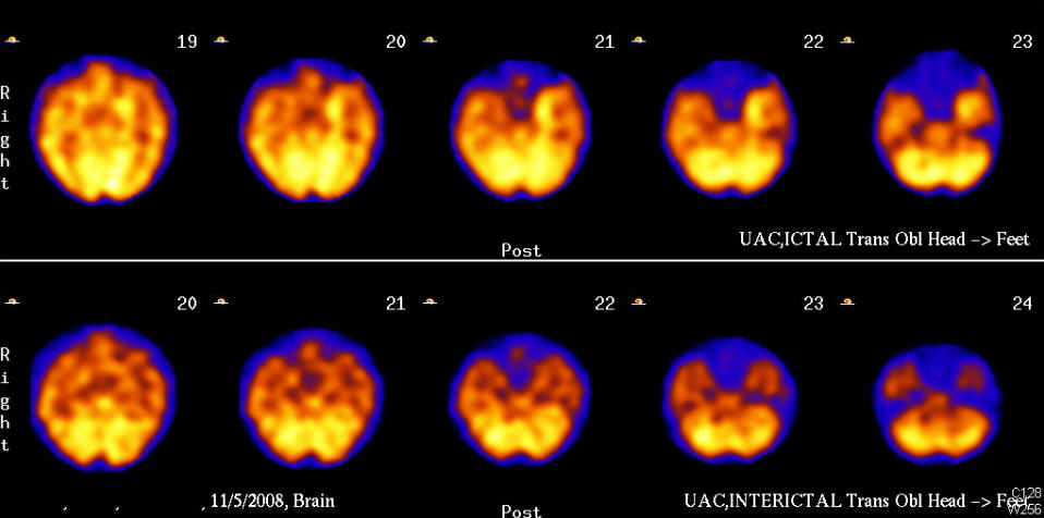HMPAO SPECT axial images: Ictal (top) and interictal (bottom).