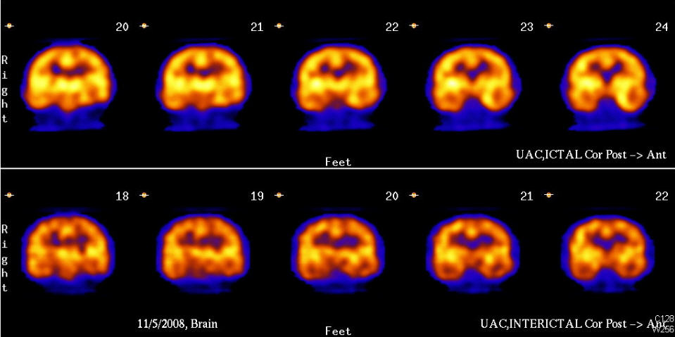 HMPAO SPECT coronal images: Ictal (top) and interictal (bottom).