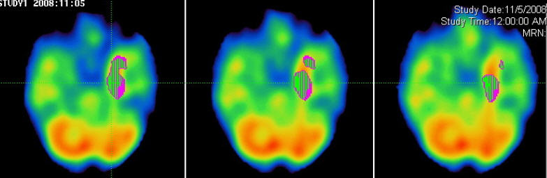 HMPAO SPECT axial images: Ictal vs Interictal subtraction images.
