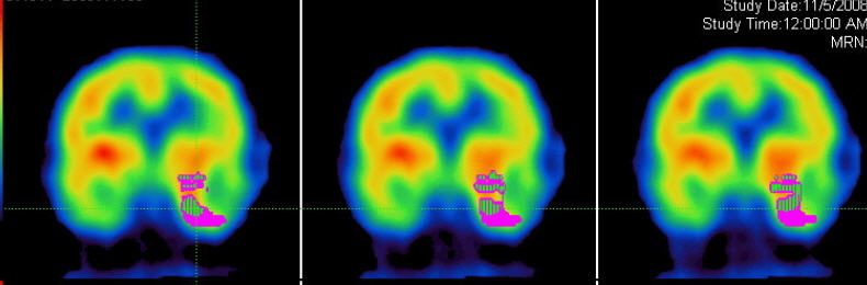 HMPAO SPECT coronal images: Ictal vs Interictal subtraction images.