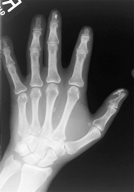 Scleroderma Hand.