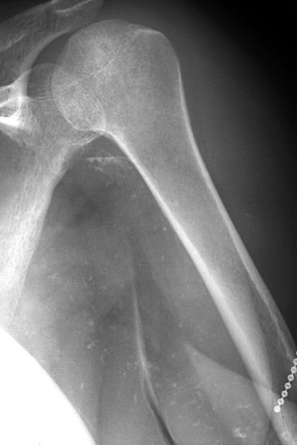 Shoulder Metastatic Ca.