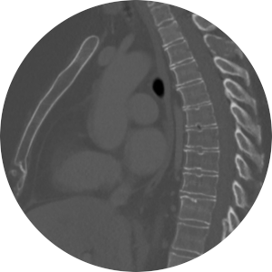 Spine CT.