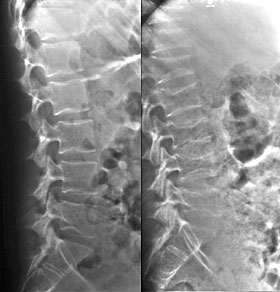 Spine on Steroids.
