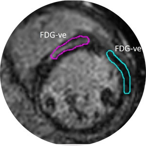 Cardiac sarcoidosis.