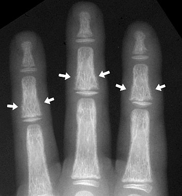 Subperiosteal Resorption.