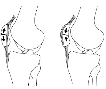 Tension Band Knee.