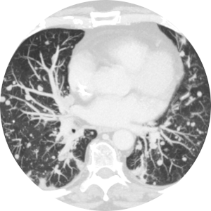 Tumor image.