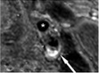 Carotid plaque