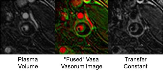 Carotid Atherosclerosis.