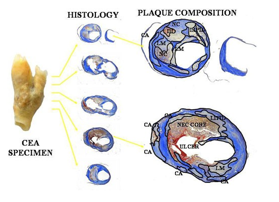 CEA histology and plaque composition.