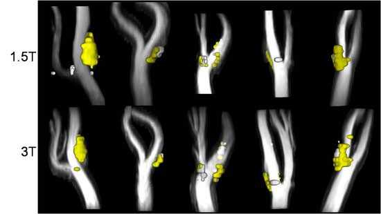 Atherosclerotic plaque.