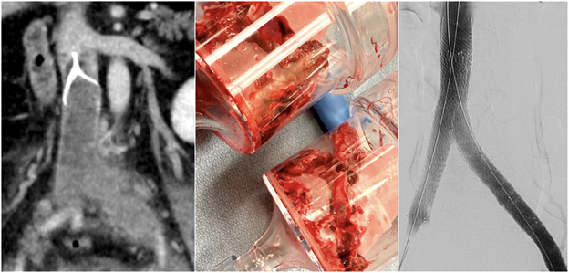 Venous Interventions Image 1 of 2.
