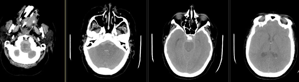 CT noncontrast.