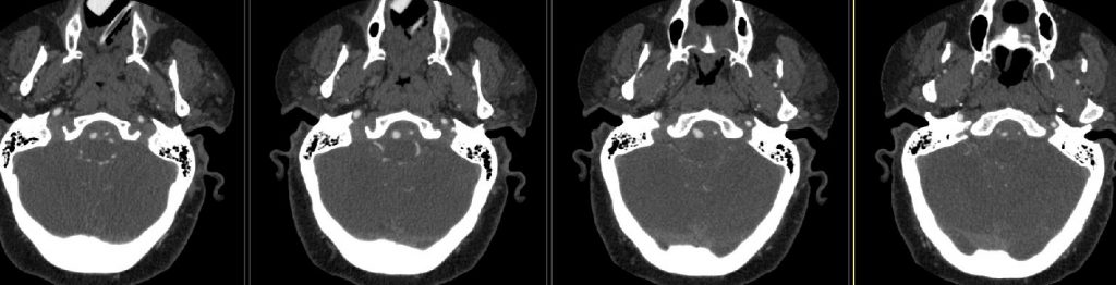 CTA axial source images.