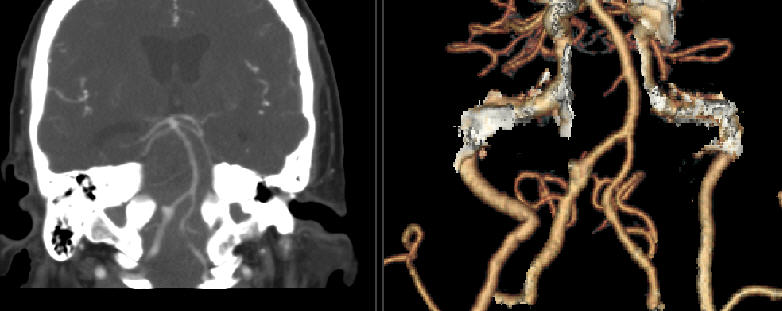 CTA coronal and 3D recons.