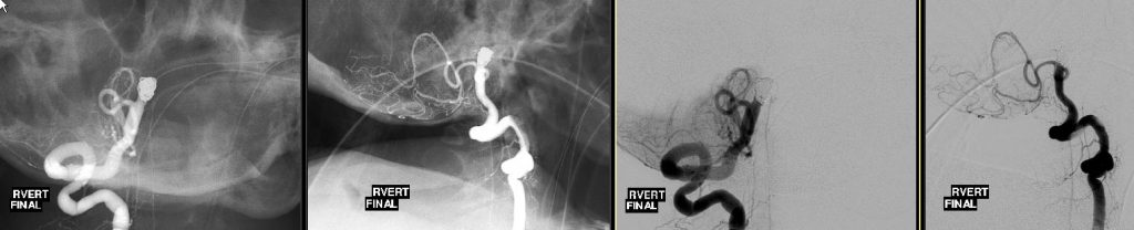 Right Vertebral artery injection AP and lateral views s/p coiling.