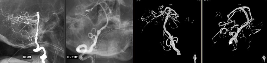 Right vertebral artery injection lateral, AP, and 3D recons.