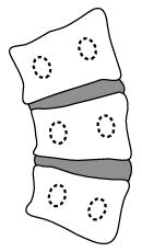 Vertebral Wedging.