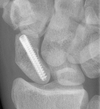 Wrist Scaphoid Detail.
