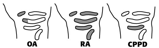 Wrists showing hotspots for OA, RA, and CPPD, respectively.