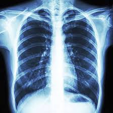 Chest xray.