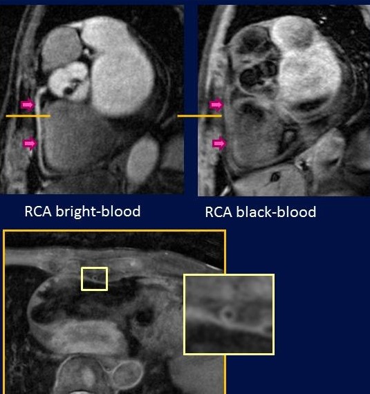 Coronary artery.