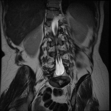 T2 Coronal.