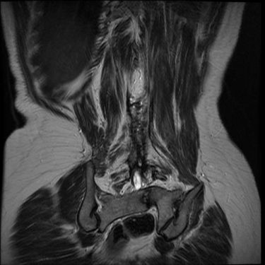 T2 Coronal.