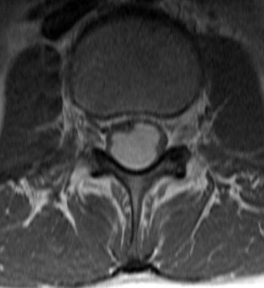 T1 axial post Gad.