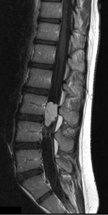 T1 sagittal post Gad.