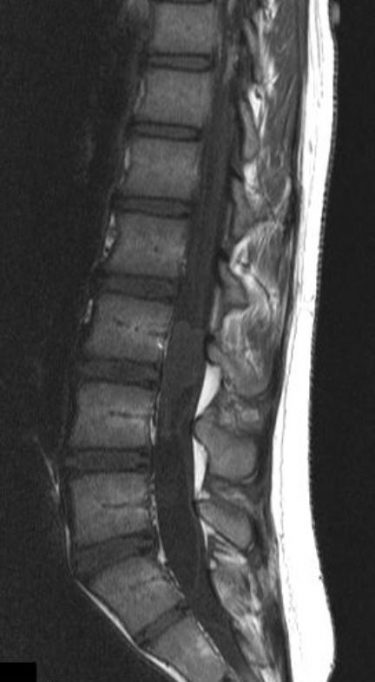 T1 sagittal noncontrast.